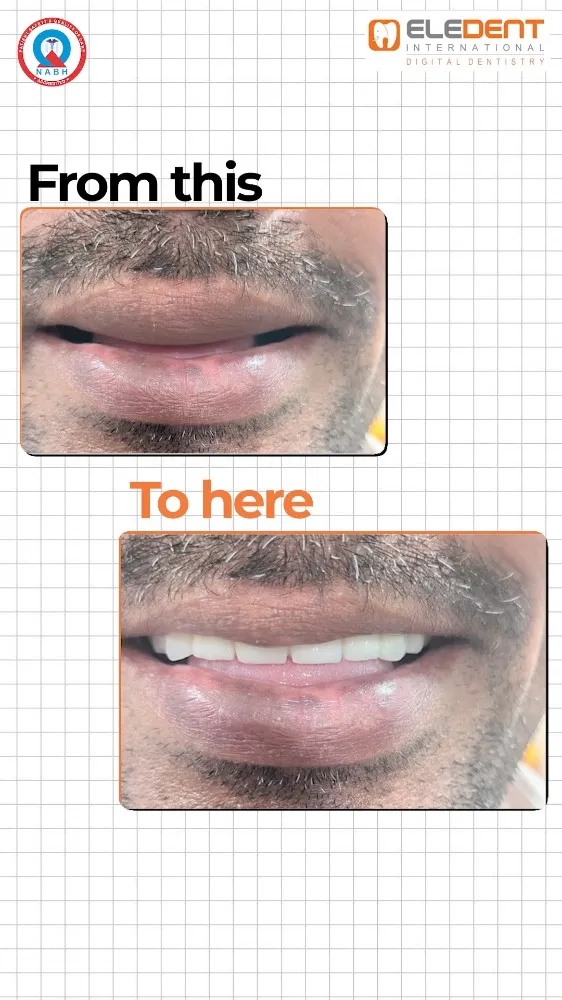 Post by Eledent Dental Hospitals | Dental Surgery